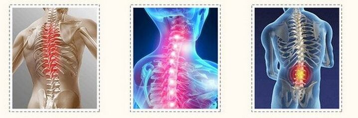 Osteocondrosi della colonna vertebrale diversa