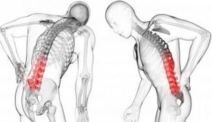 Ernia vertebrale intermedia - complicazione con osteocondosi