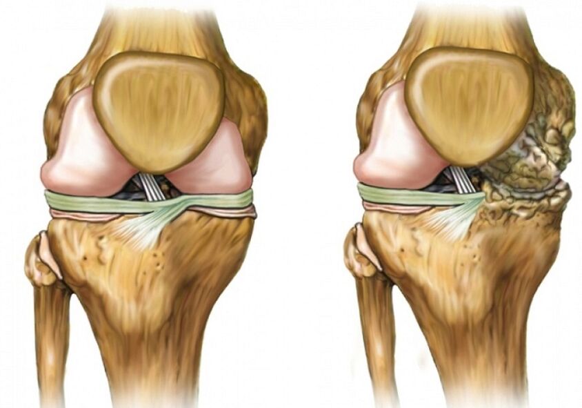 Osteoartrosi del ginocchio