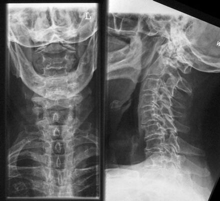 Diagnosi di raggi X cervicale del metodo dell'osteocondrosi