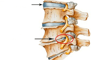 Colonna vertebrale normale e danneggiata con osteocondosi cervicale