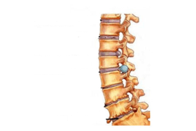Danni alla colonna vertebrale con osteocondrosi cervicale