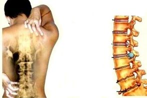 Dolori alla schiena in diverse fasi dello sviluppo dell'osteocondosi cervicale
