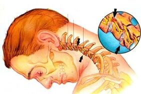 nervo pizzicato nella colonna vertebrale con osteocondosi cervicale