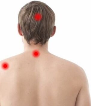 Posizione del dolore nell'osteocondrosi cervicale