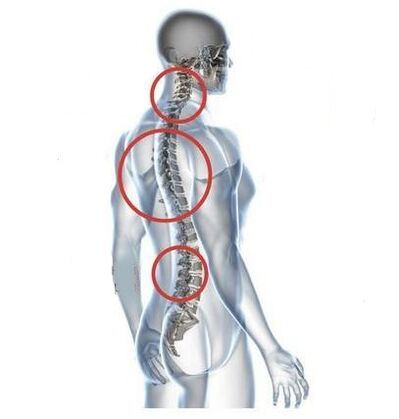 Sedi di osteocondrosi spinale