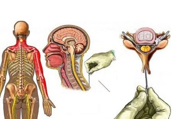 Trattamento dell'osteocondrosi cervicale con agopuntura