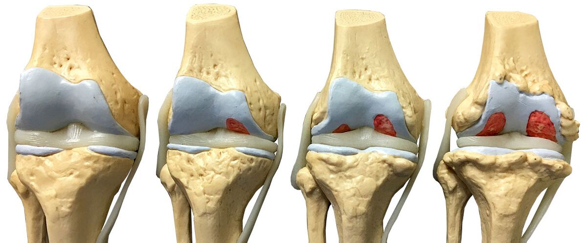 Fasi dell'osteoartrosi