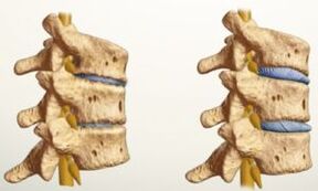 Che aspetto ha l'osteocondrosi