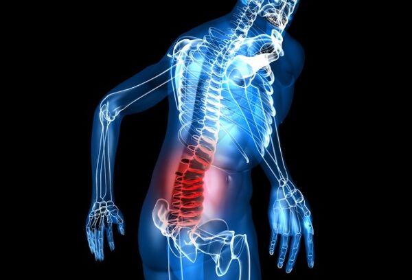 Cos'è l'osteocondrosi lombare