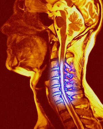 Condrosi cervicale
